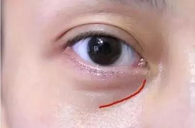 手术去眼袋有风险吗它的副作用能整明白不