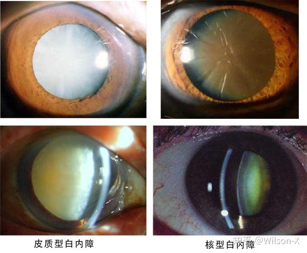 白内障之症状篇——"医生,我咋慢慢的看不清了?