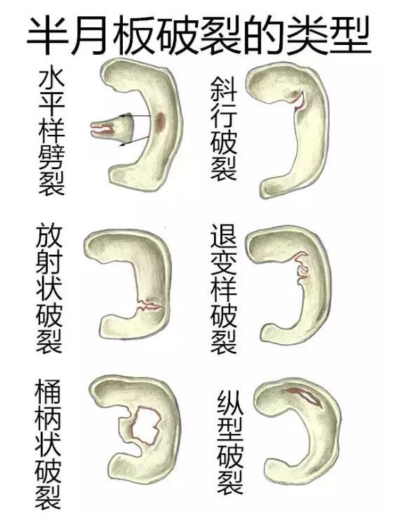 半月板损伤的典型症状:疼痛,膝关节交锁(即卡住感),屈曲,伸直活动范围