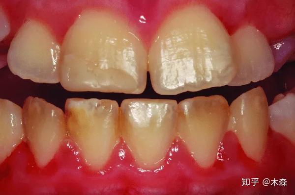 孩子如果有这样的牙齿可能是存在乳糜泻牙釉质缺陷与乳糜泻
