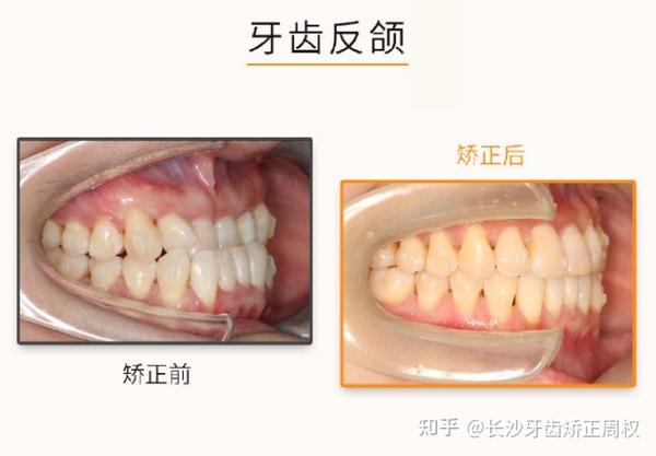 长沙牙套正畸:什么是反颌(地包天),附反颌案例展示