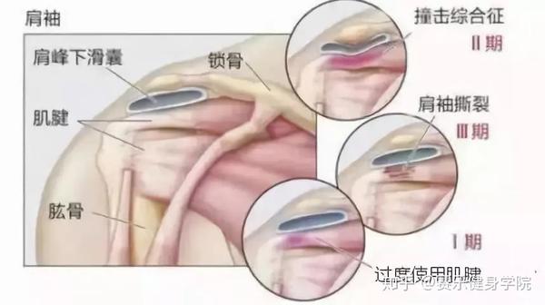 构成肩峰撞击综合征的疾病包括 肩峰下滑囊炎,冈上肌钙化性肌腱炎,肱