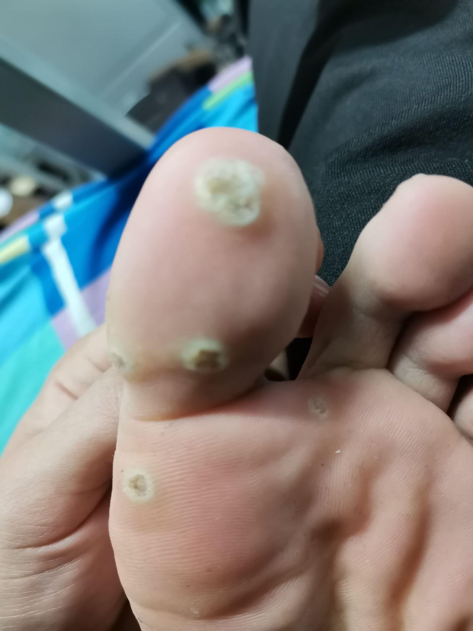 得了趾疣是一种什么样的体验怎么样才能治好