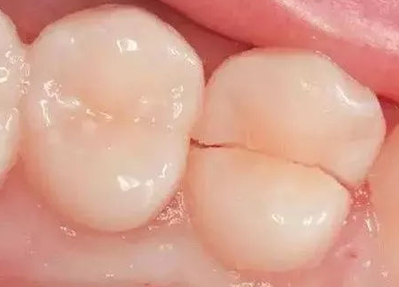 医生:多半是牙齿折裂了,初期治疗很重要