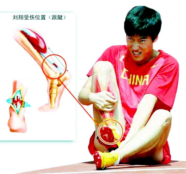 跟腱炎的运动康复