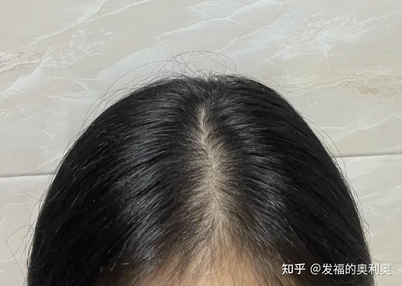 女生发量少头顶快秃了有没有什么好的生发方法跪求