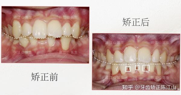 (拥挤的牙齿矫正后出现黑三角,无法避免)