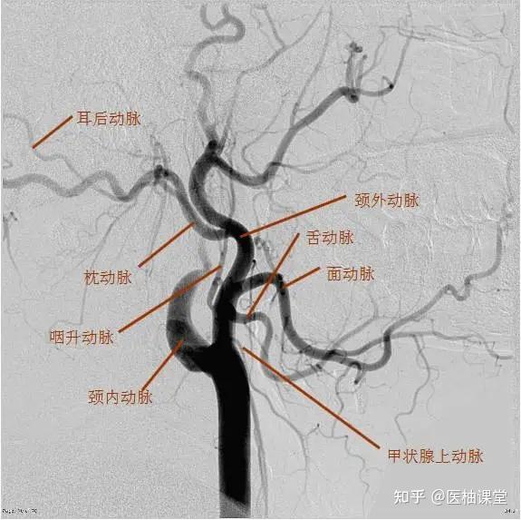 颈外动脉解剖dsa图