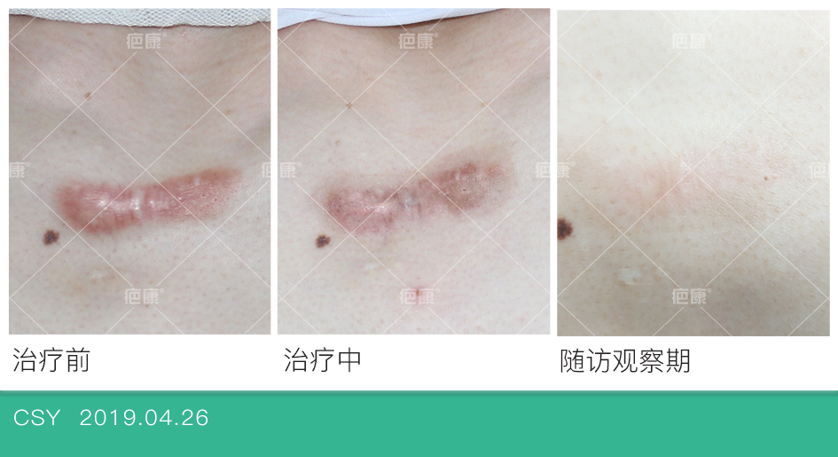 瘢痕疙瘩案例单纯药物注射治疗再次复发概率超80
