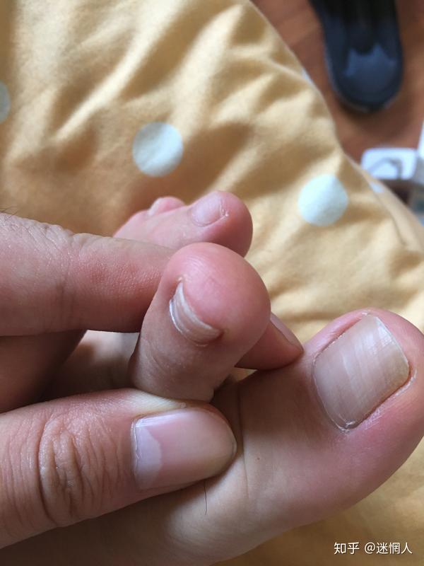 鸡眼怎么能快速根除