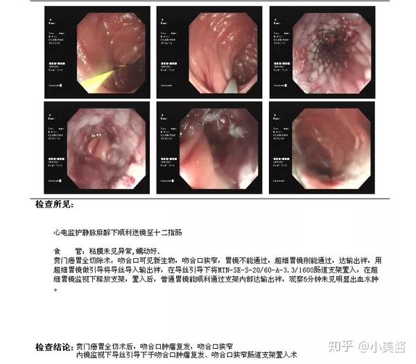 73岁的孙大爷是一名贲门癌术后2年的患者,于半年前出现进食困难,近一