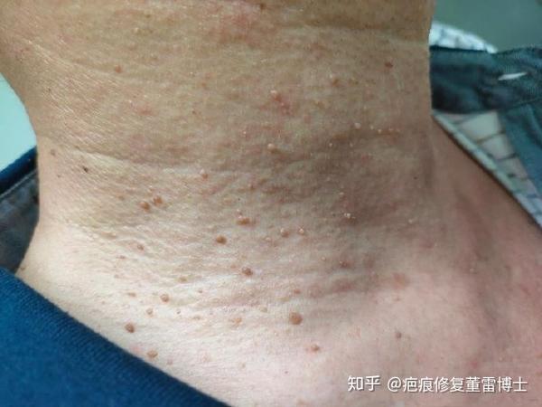 脖子上这些小肉疙瘩,除了不好看,而且密密麻麻的看着密集恐惧症都要犯