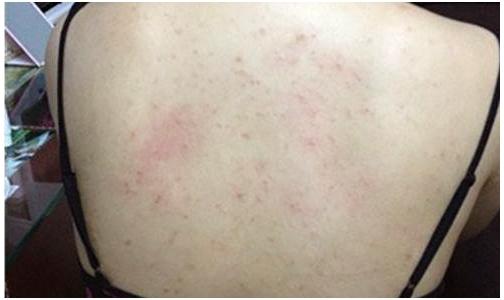 背上长痘痘是什么原因造成的,3大原因告诉背部祛痘的方法?