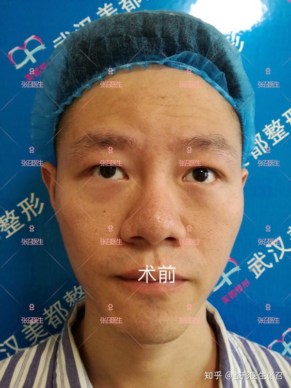 鼻头肥大缩小的方法