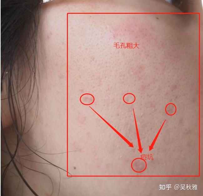 请问我脸上这种痘坑还是毛孔粗大,那应该怎么治疗呢?