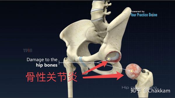 髋关节骨性关节炎和表面置换术