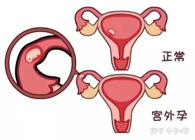 异位妊娠:异位妊娠又叫宫外孕,是孕早期出血最危险的原因之一.