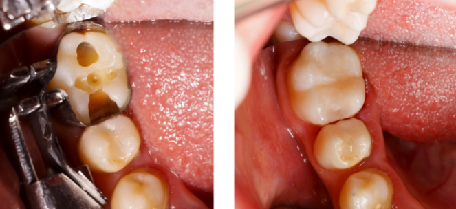 【上海圣贝口腔小tips】补牙患者都好奇:为什么补牙要