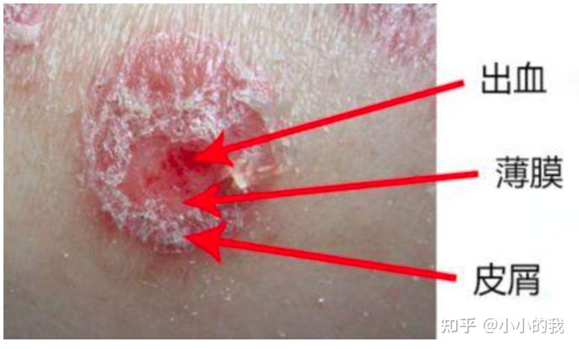 俗称牛皮癣,一种常见的慢性复发性炎症性皮肤病,基本损害为红色丘疹或