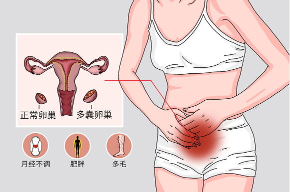 多囊卵巢综合症你了解吗?