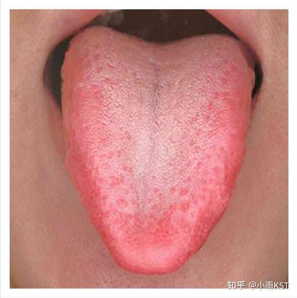 如儿童舌质多淡嫩或红嫩,蕈状乳头常显露明显,舌苔薄少(图1-18);老年