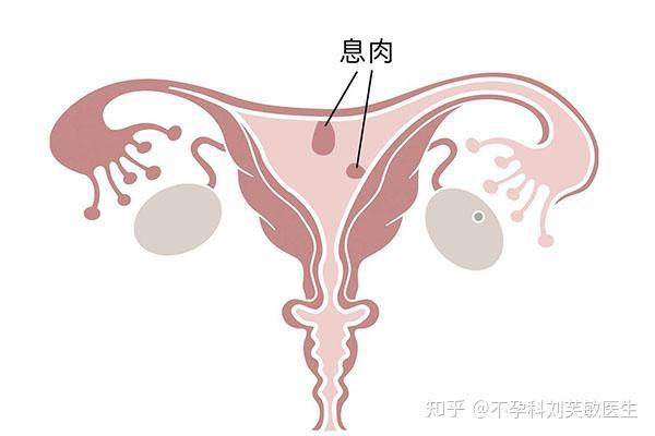 子宫内膜息肉的诊断与治疗