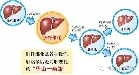 肝硬化是怎么引发的?我们该怎么去预防!