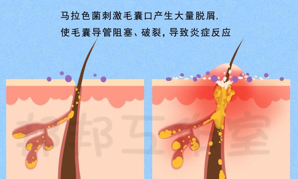 胸背上的"小痘痘",得了马拉色菌毛囊炎该怎么办?