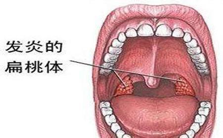 孩子扁桃体发炎反反复复