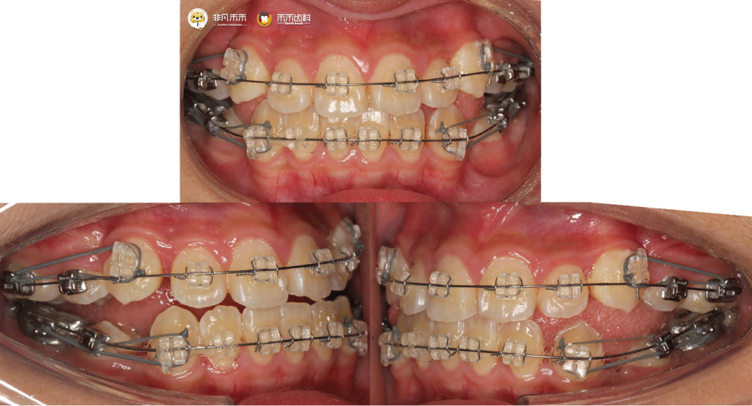 使用非凡禾禾蓝宝石单晶托槽矫治计划:4. 建立良好咬合关系3.