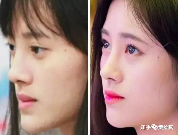 隆鼻术后通天鼻阿凡达?盘点山根的重要性.