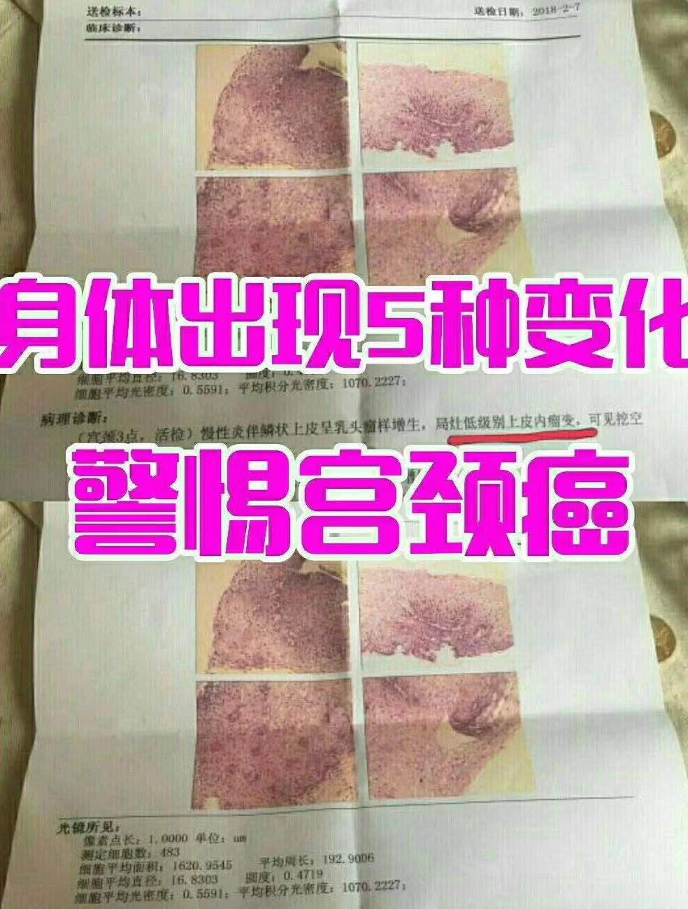 宫颈癌很会装,早期的症状不怎么明显,至容易跟月经不调,其他简单的