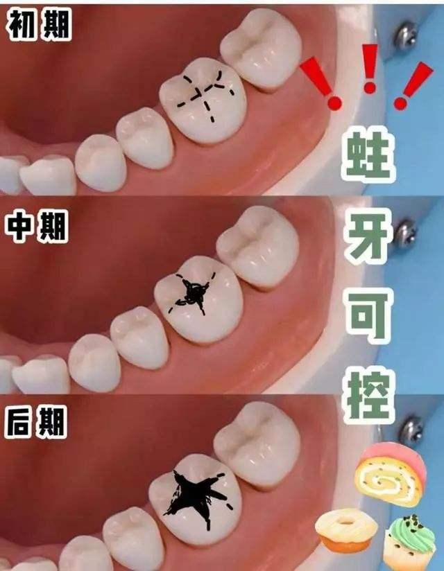 牙齿上的黑线怎么回事牙齿
