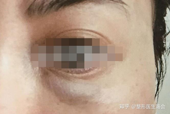 注射玻尿酸后出现"丁达尔"现象