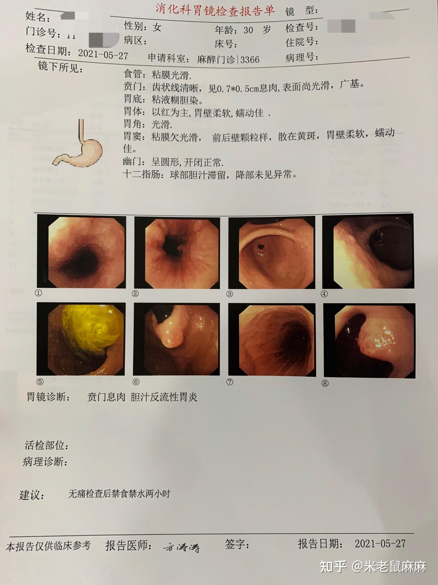 今天第一次做了无痛胃镜,检验结果如下:贲门息肉 胆汁返流性胃炎.