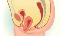 产后问题:子宫脱垂阴道壁膨出了怎么办