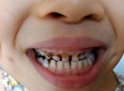 案例6岁小男孩补过的牙齿疼痛的厉害吃饭都难以下咽这到底是怎么回事