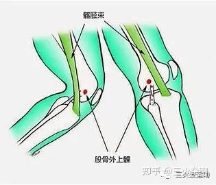 认识髂胫束摩擦综合症