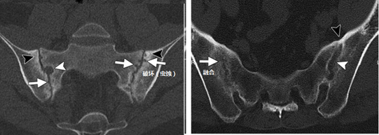 【强直性脊柱炎】说骶髂:第一篇