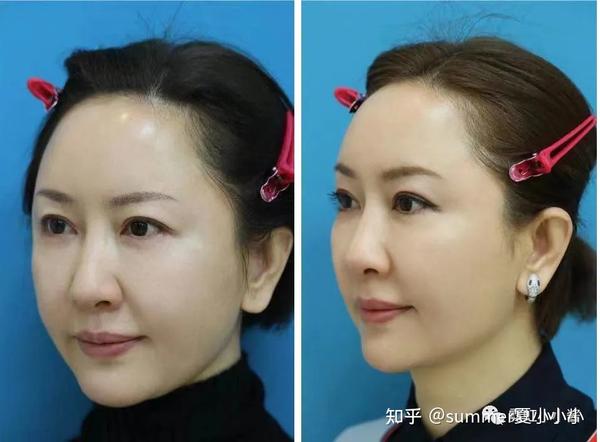 ▽ 是不是脸部感觉被去肿了,面颊薄了,法令纹和木偶纹减轻,下颌线也比