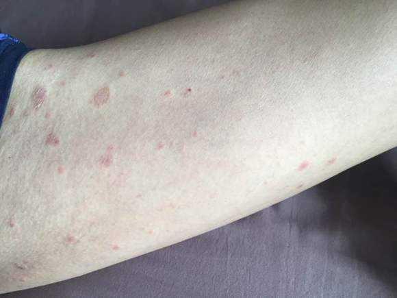 【郑州皮肤科】秋冬季节容易发作的皮肤病—玫瑰糠疹
