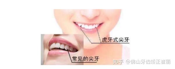 佛山牙齿矫正丨俏皮虎牙,是"可爱"还是"可怕"?