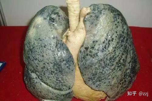 有没有抽烟二十年以上肺部的图片?