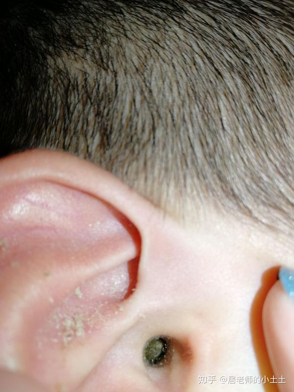 无意间看到我弟的耳朵 太可怕了 耳屎圆球. 于是给他努力的掏了一下.