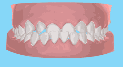 拔牙是矫正中比较常见的一种获得间隙的方式,正确的拔牙矫正不仅不会