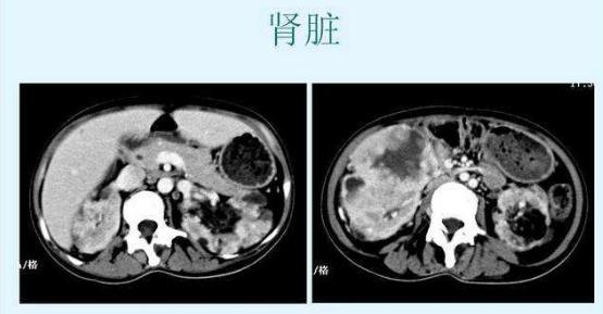 7人 赞同了该文章 结节性硬化肾错构瘤属于一种良性肿瘤,单个或多个