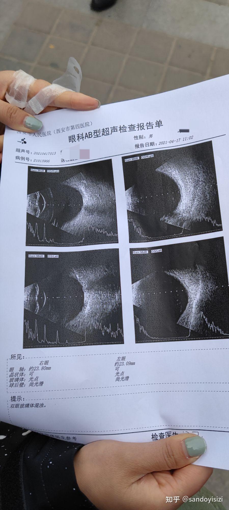 得了玻璃体混浊是一种怎样的体验?