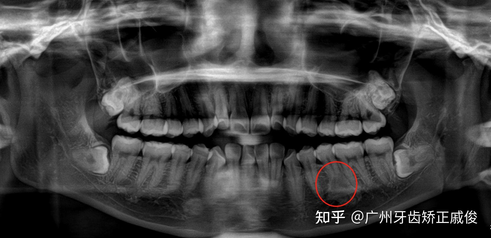 广州牙齿矫正|下巴后缩竟是关节病变?