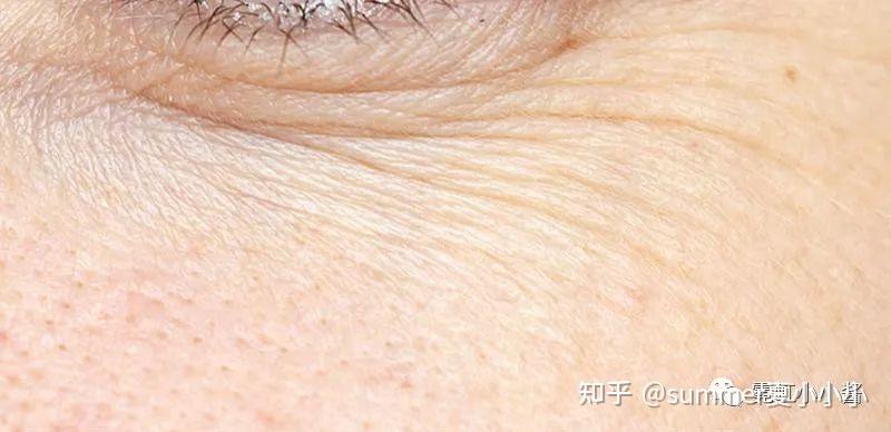 眼周皱纹每天都在提醒衰老全年龄眼部解决方案来了日本医美