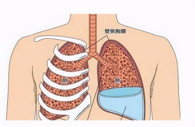 其中,大约60%的肺癌晚期患者可能有恶性胸腔积液,此外乳腺癌,肝癌,其